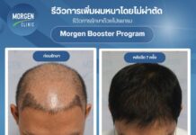 ฉลอง 5 ปี ‘มอเก้นคลินิก’ ดิสรัปต์วงการปลูกผม เปิดตัวนวัตกรรมใหม่ “ไม่ต้องผ่าตัด” พร้อมหั่นราคา 30%