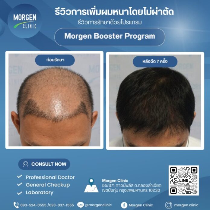 Morgen Clinic Hair Transplant